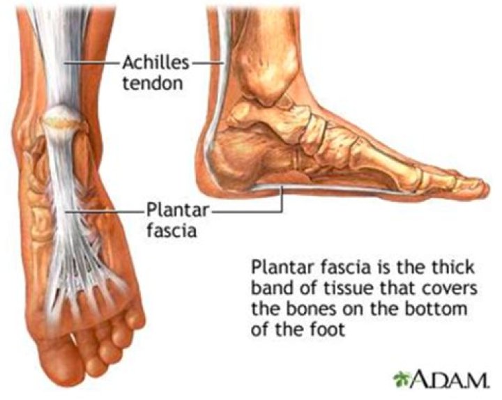 Can Plantar fasciitis become chronic?
