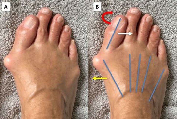 Can RA cause hallux valgus?