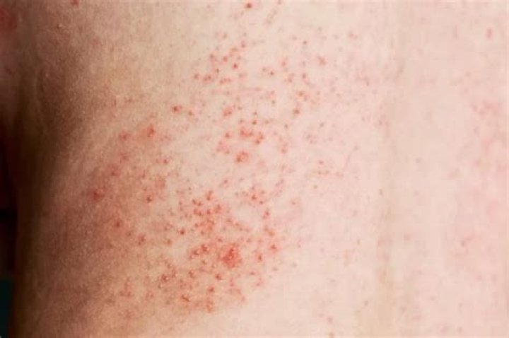 Can sauna cause itching?