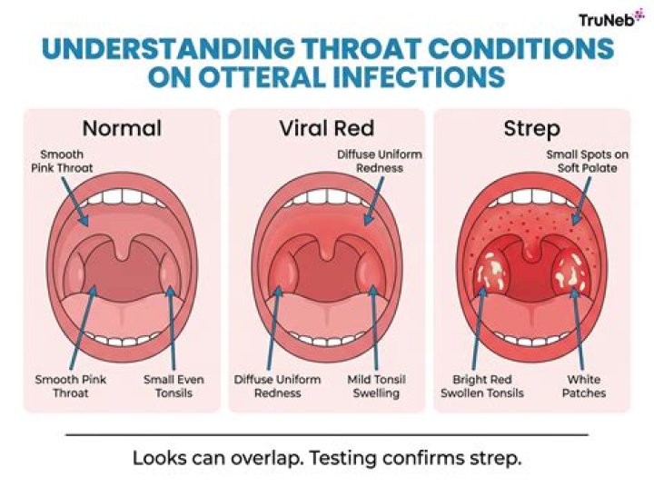 Can strep cause tingling?