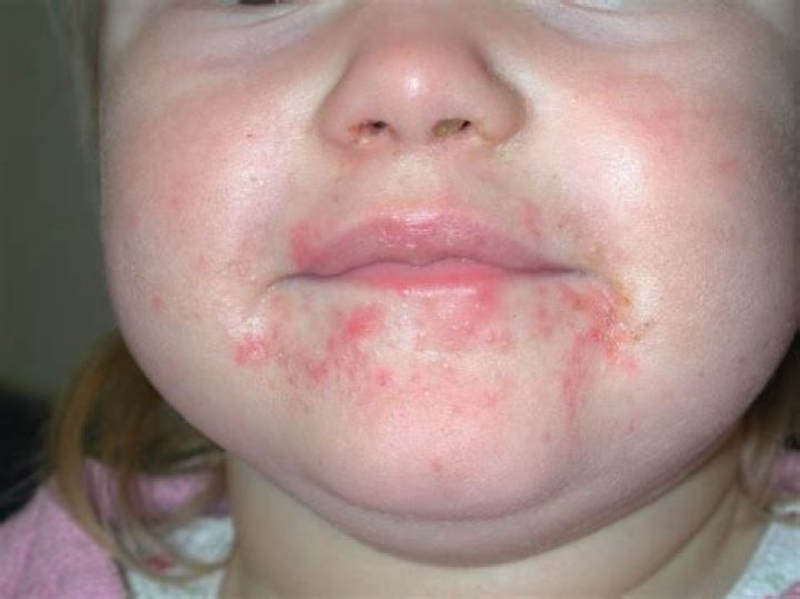 Can teething cause one red cheek?