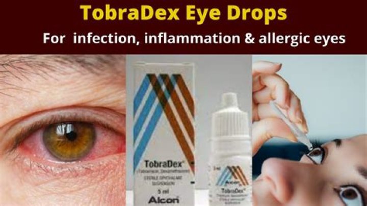 Can Tobradex be used for conjunctivitis?