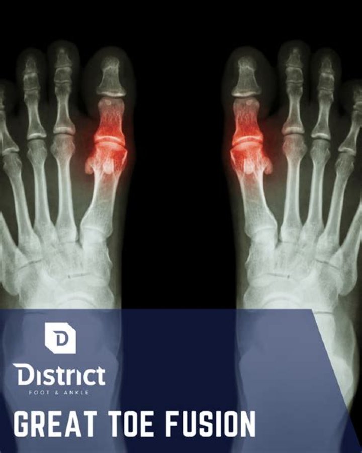 Can toe joints be replaced?
