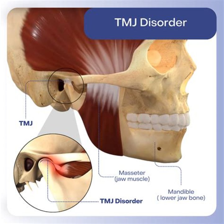 Can trauma to the jaw cause TMJ?
