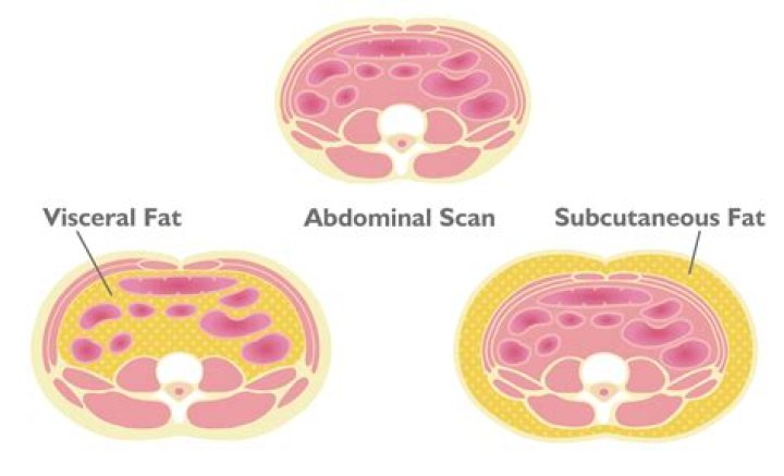 Can visceral fat be liposuctioned?