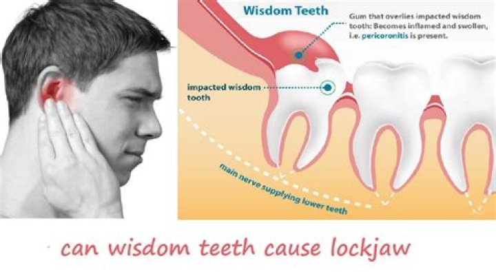 Can wisdom teeth cause jaw locking?