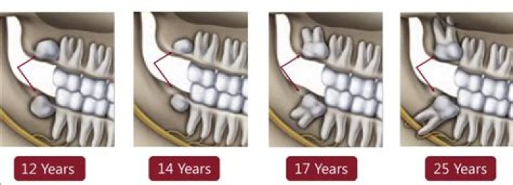Can wisdom teeth come in at age 40?