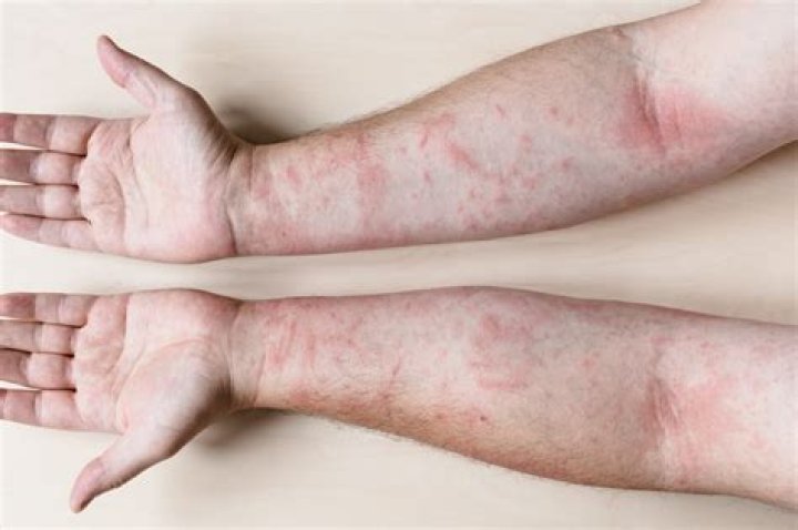 Can you be allergic to hydraulic fluid?