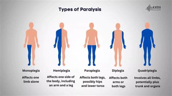 Can you be paralyzed from the neck down?