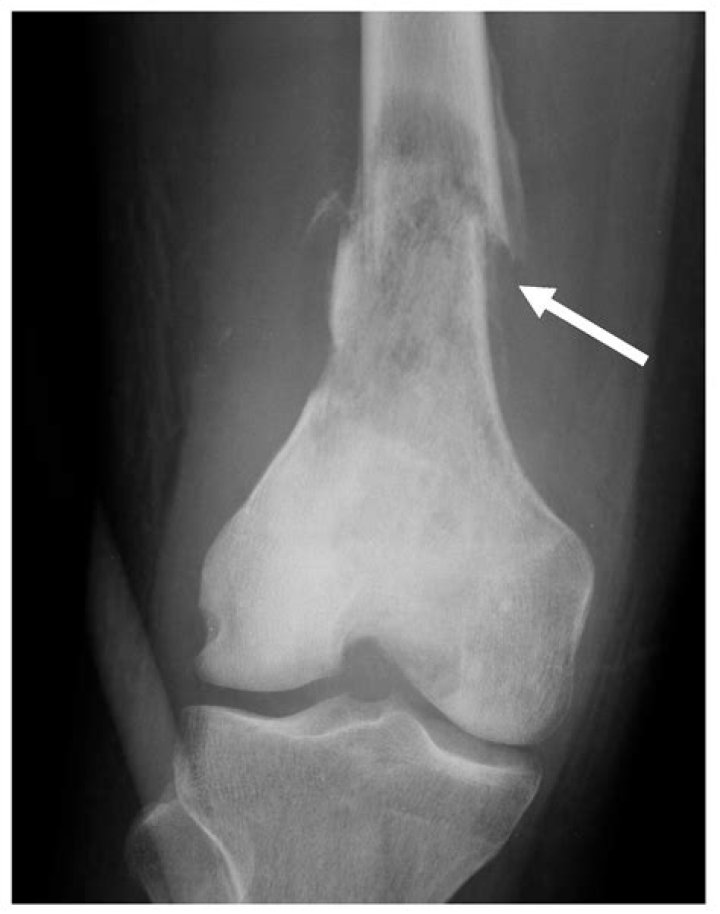 Can you die from osteosarcoma?