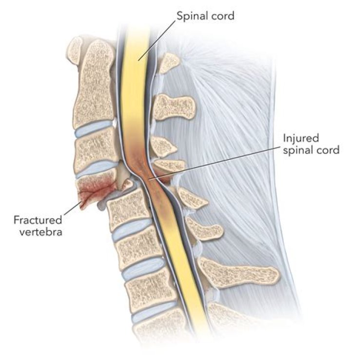 Can you dislocate your spinal cord?
