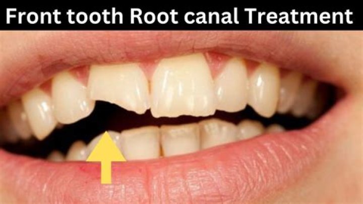 Can you do a root canal on a front tooth?