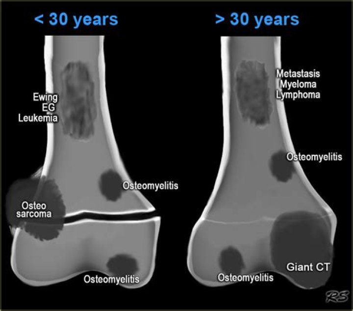 Can you feel a bone tumor?
