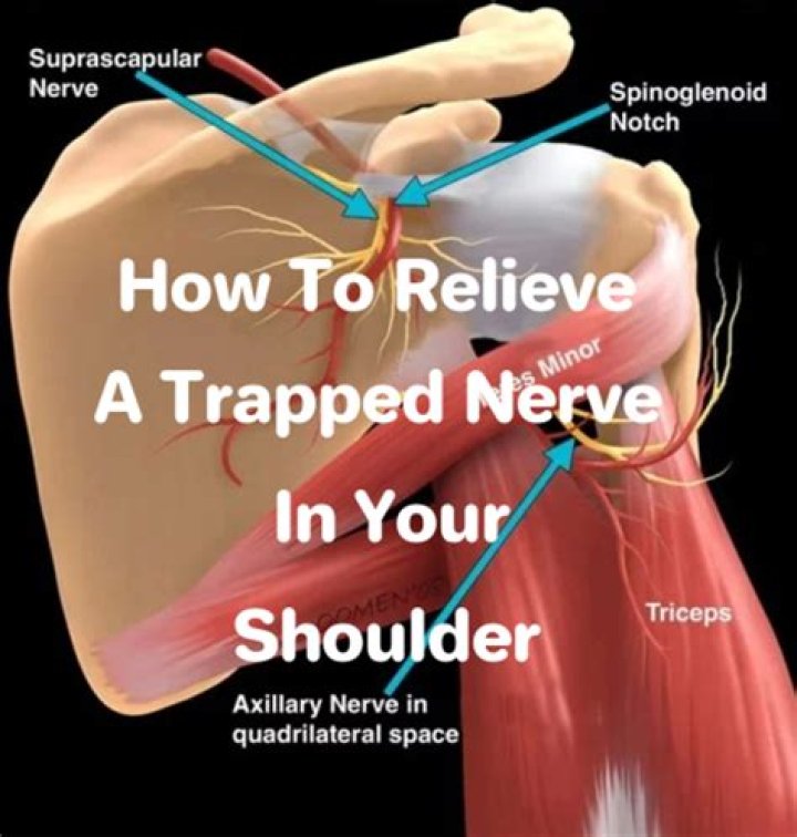 Can you get a trapped nerve in your collarbone?