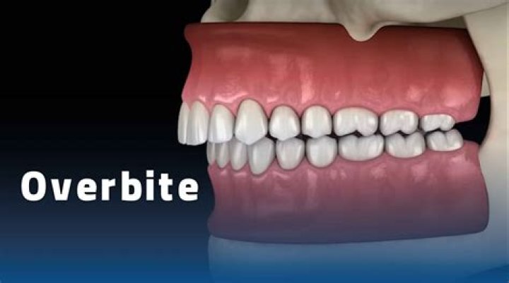 Can you get dentures with an overbite?