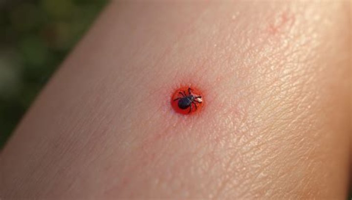 Can you get MS from a tick bite?
