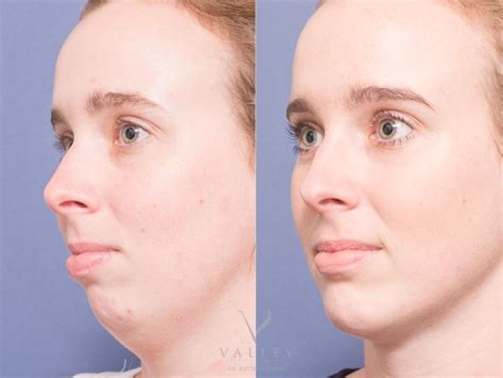 Can you get surgery on your chin?