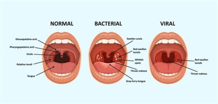 Can you have nasal congestion with strep throat?
