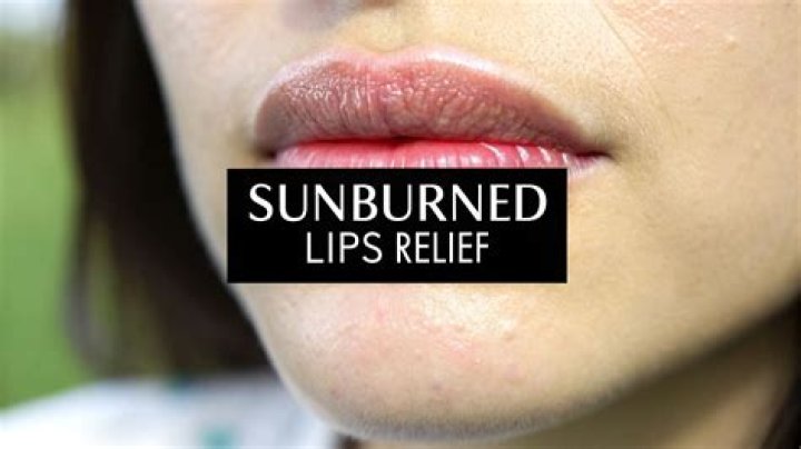 Can you put chapstick on sunburned lips?