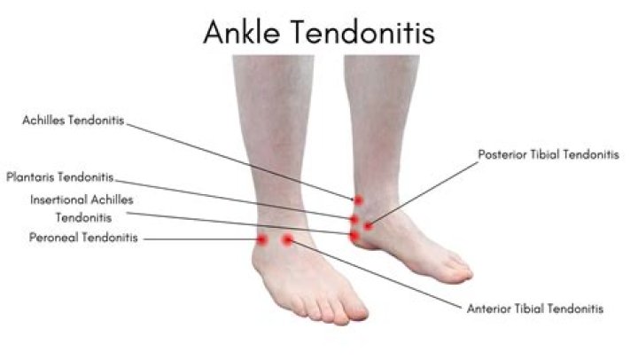 Can you run with ankle tendonitis?