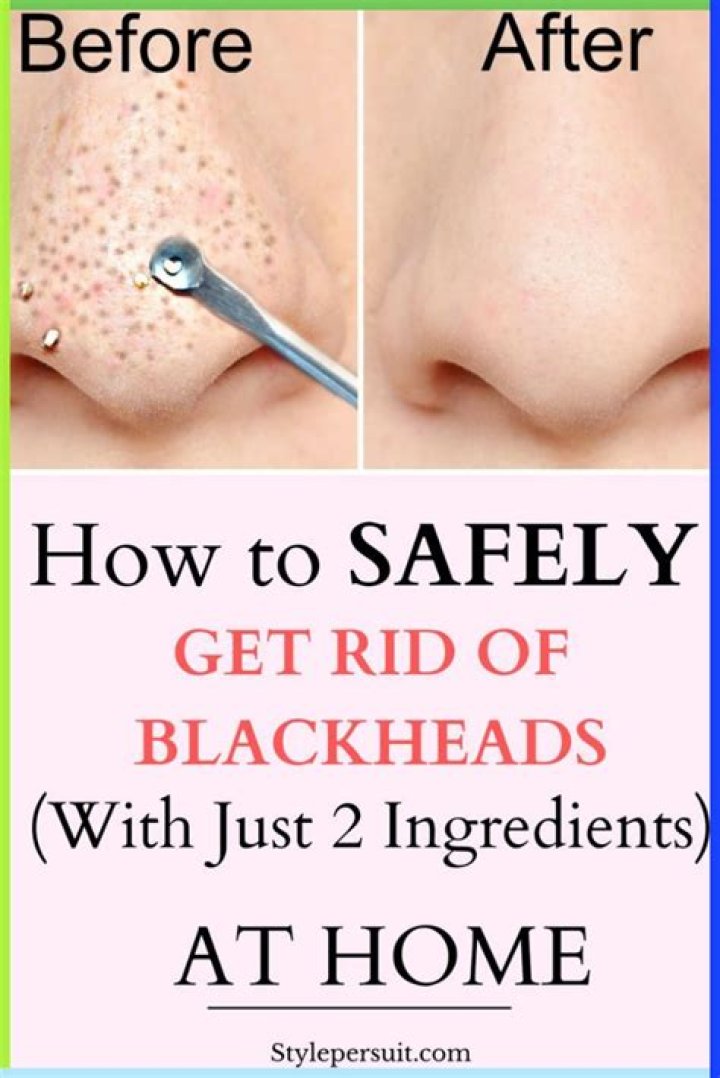 Can you scrape blackheads off?