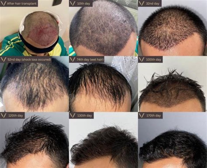 Can you sue for a bad hair transplant?