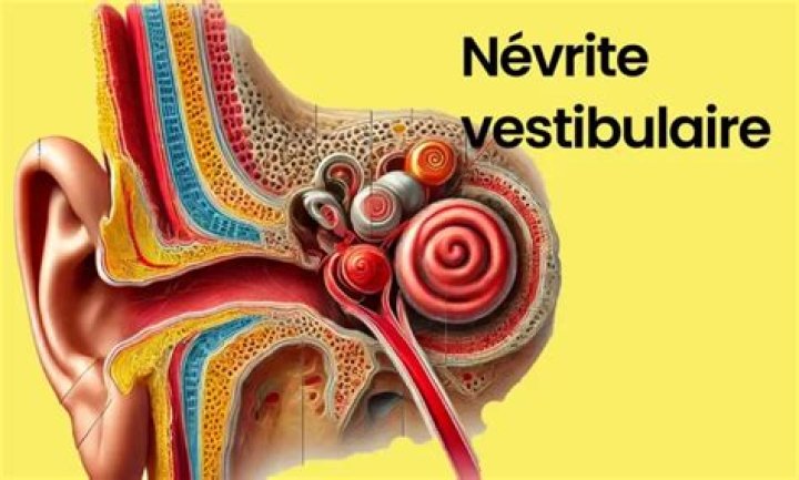 Comment diagnostiquer Nevrite vestibulaire ?