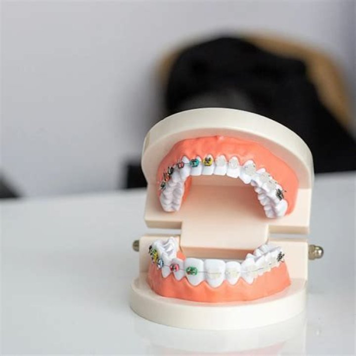 Comment nettoyer son appareil d'orthodontie ?