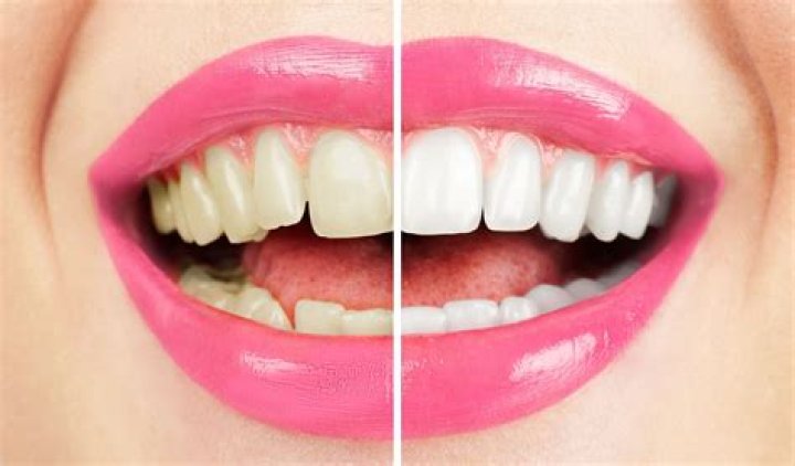 Comment se passe le blanchiment des dents chez le dentiste ?