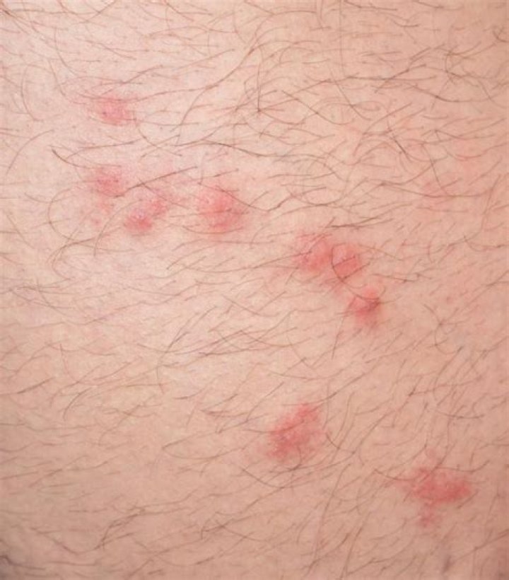 Como identificar os tipos de picadas de insetos?