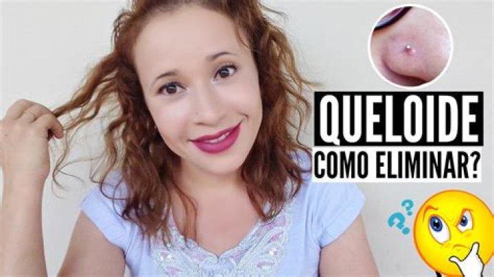 Como tirar queloide de piercing caseiro?