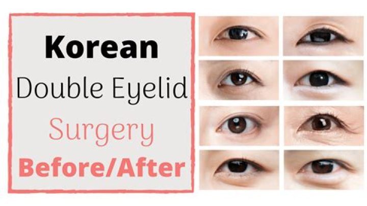 Do Asians have 2 eyelids?