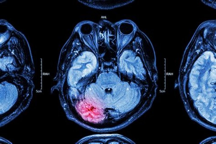 Do Brain Injuries always show on MRI?