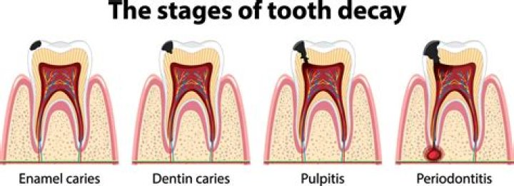 Do cavities cause acne?