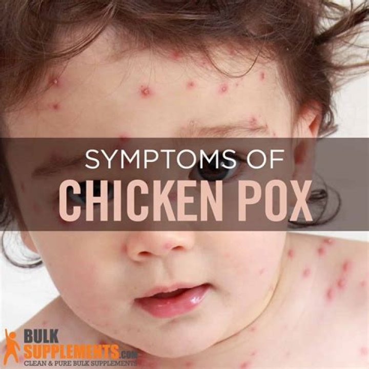 Do chickenpox pop like zits?