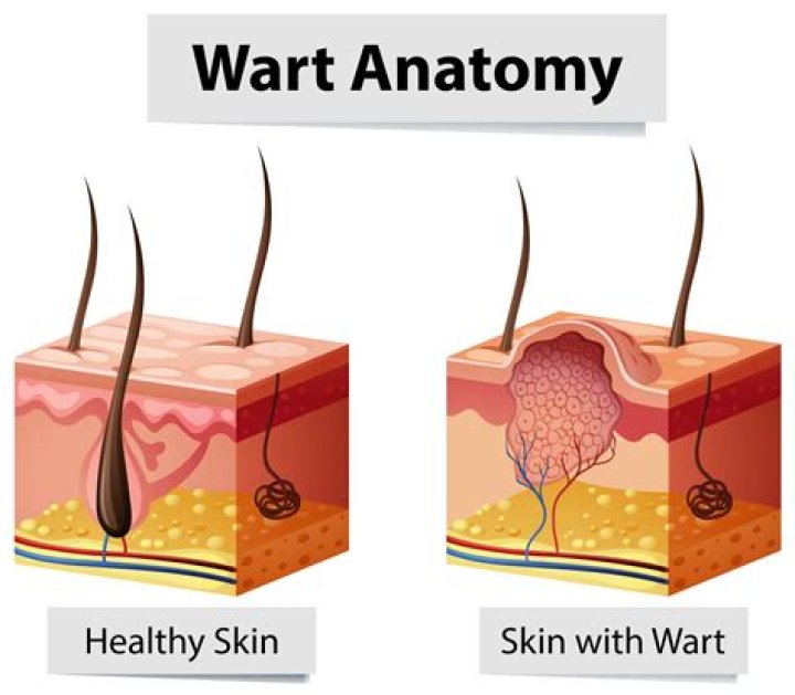 Do facial warts go away on their own?