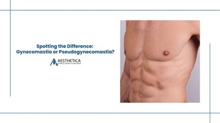 Do I have gynecomastia or Pseudogynecomastia?