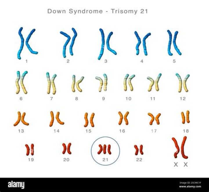 Do people with Down syndrome have too many chromosomes?