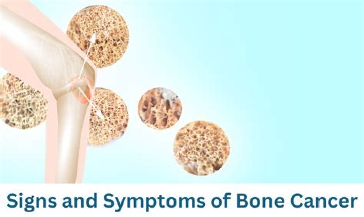 Do you always have pain with bone cancer?