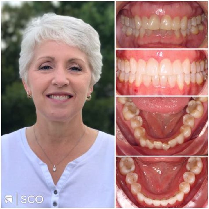 Do you have to wear a retainer after veneers?