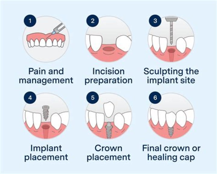 Do you need a crown after an implant?