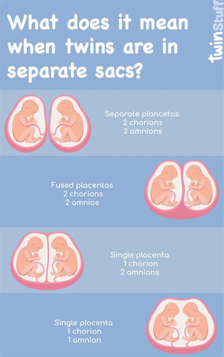 Does 2 sacs always mean twins?