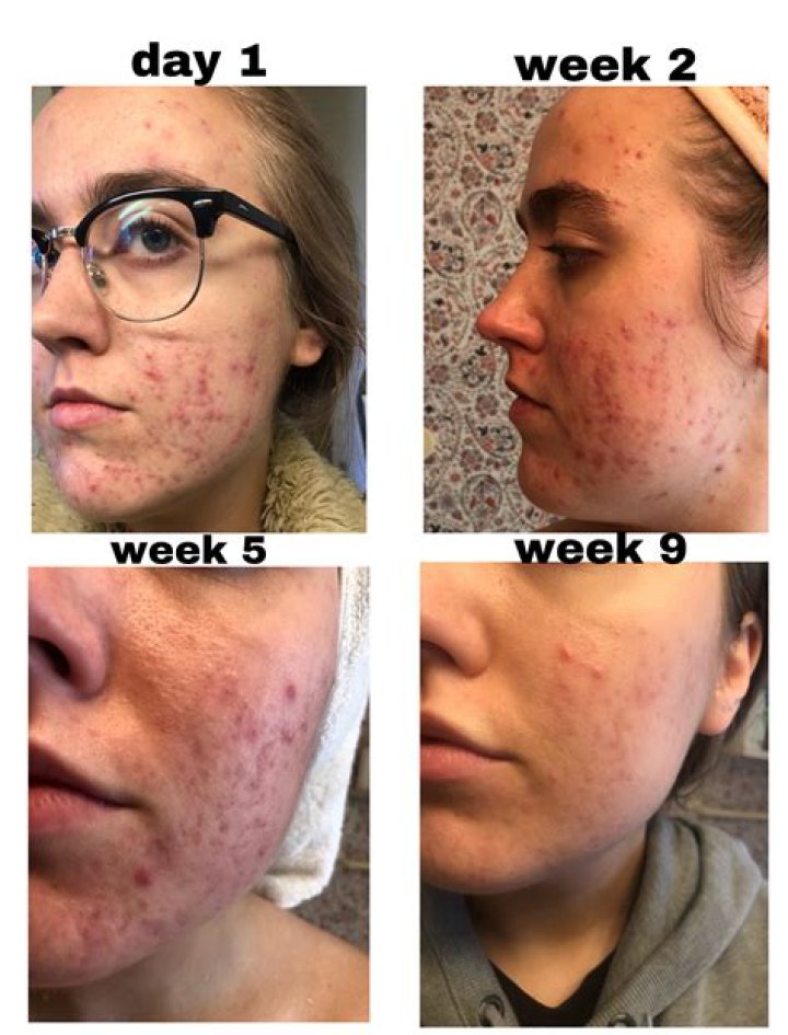Does adapalene and benzoyl peroxide help acne scars?