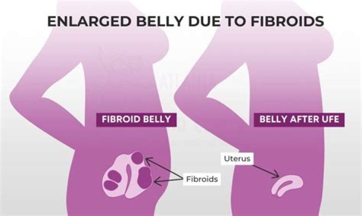 Does being overweight cause fibroids?