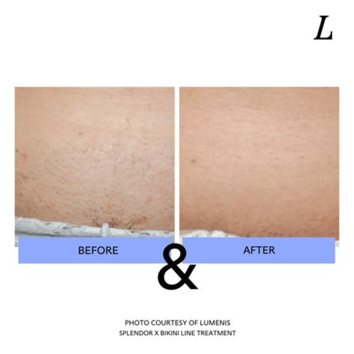 Does Brazilian laser hair removal include buttocks?