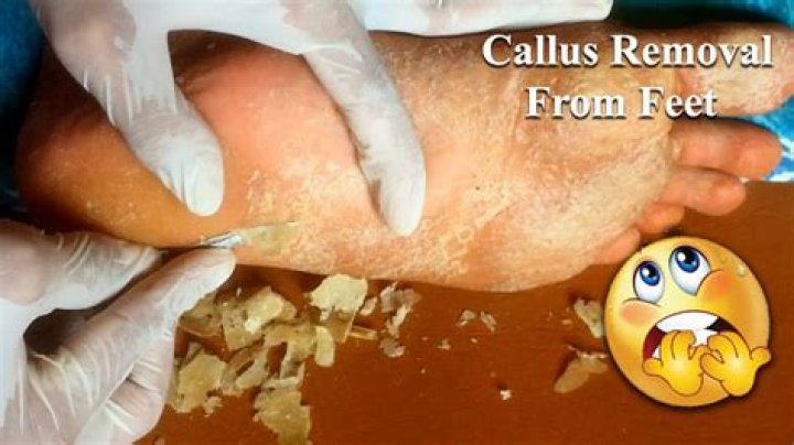 Does callus remover really work?
