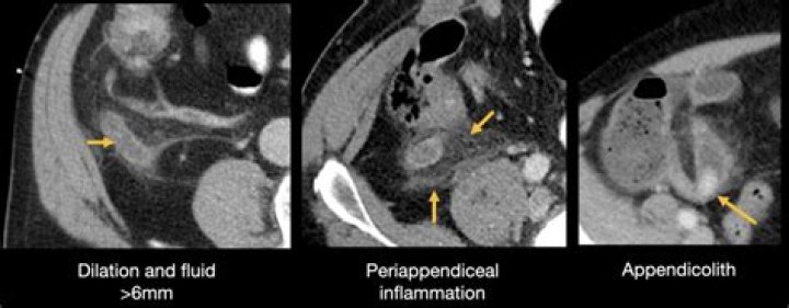 Does chronic appendicitis show on CT scan?