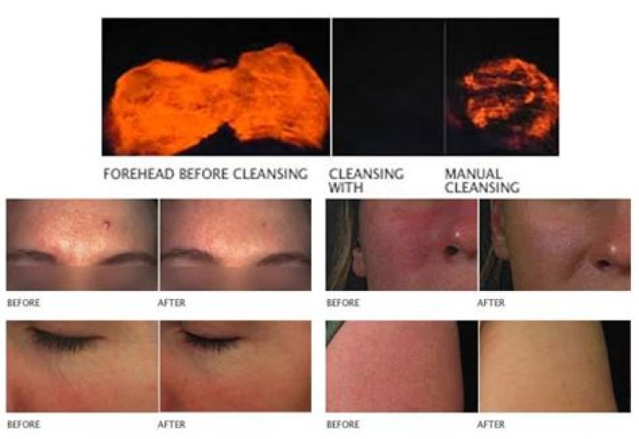Does clarisonic make a difference?