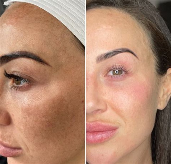 Does Cosmelan Peel help with wrinkles?