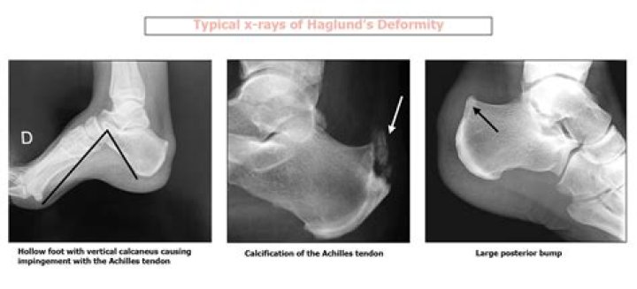 Does Haglund's deformity go away?